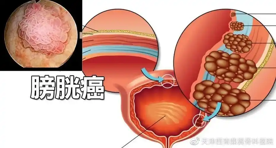 膀胱癌是起源于膀胱尿路上皮的恶性肿瘤,目前已成为世界范围高发病率