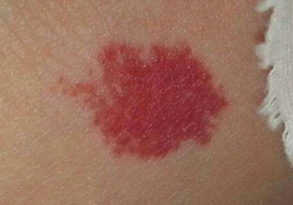 胥肖琴医生:宝宝身上的红胎记越来越红是怎么回事?