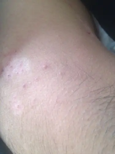 我背上有汗斑医生配了醋酸溶液,用了一个星期脖子上长了一点点东西是