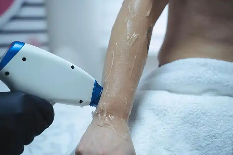 激光脱毛图片下载