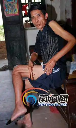 三亚光鸭批发户被黑帮亲戚挑断脚筋度日难(图)