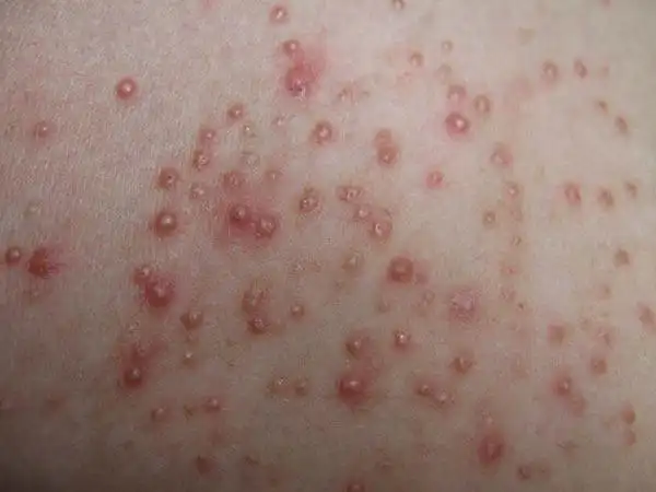 球菌侵入毛囊部位所发生的化脓性炎症,是生活中很常见的一种皮肤病,初