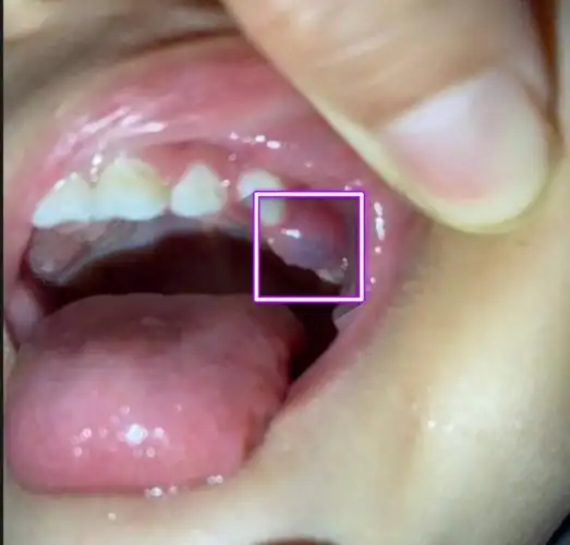 宝宝牙龈血肿?_儿童牙病_儿童牙病相关疾病 - 好大夫在线
