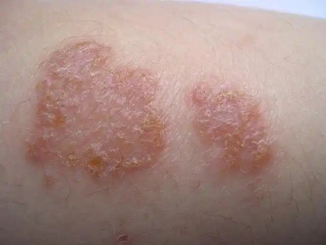 虫咬性皮炎,儿童丘疹性肢端皮炎临床症状较相似,要注意鉴别