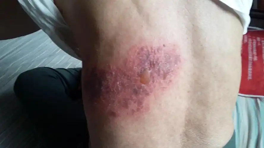 老年大疱性带状疱疹. - 皮肤及性传播疾病讨论版 - 爱爱医医学论坛