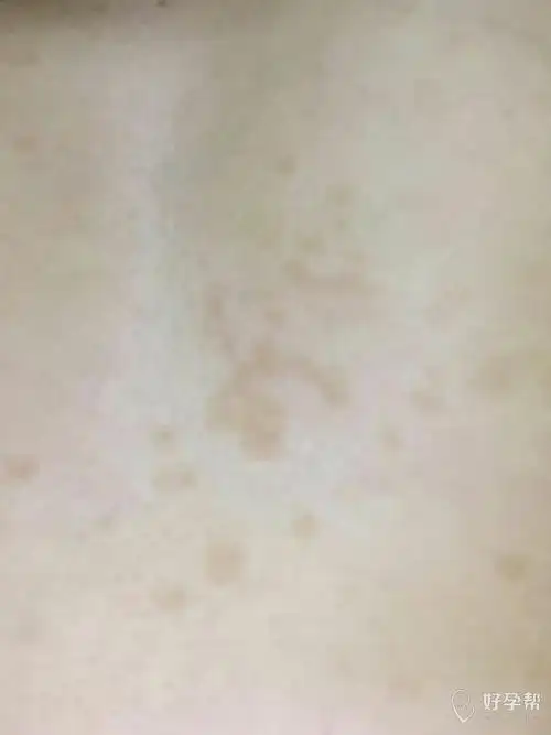 痘印变成褐色斑怎么办