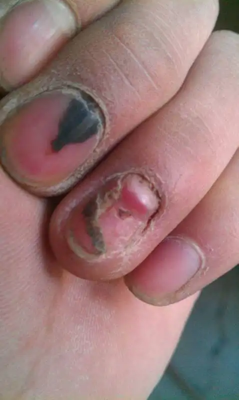 手指被车门夹伤,十几天了,现在的新指甲鼓起来了,跟变形似的,这正常吗
