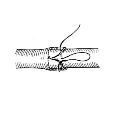 并吊缝套入段对应部位的外膜和部分中膜,打结后修复血管的切开部分