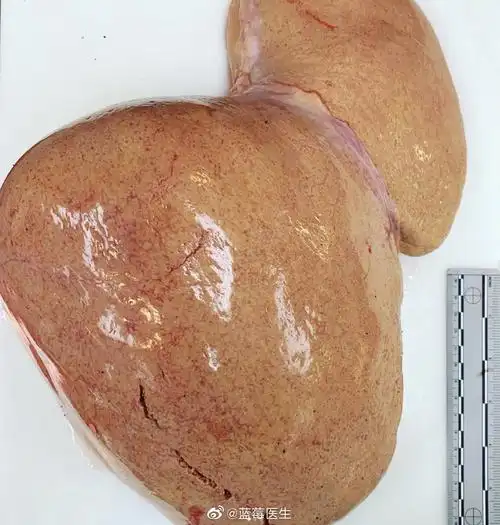 脂肪肝的外表和切片放大观察,图3是正常对照肝_高清图集_新浪网