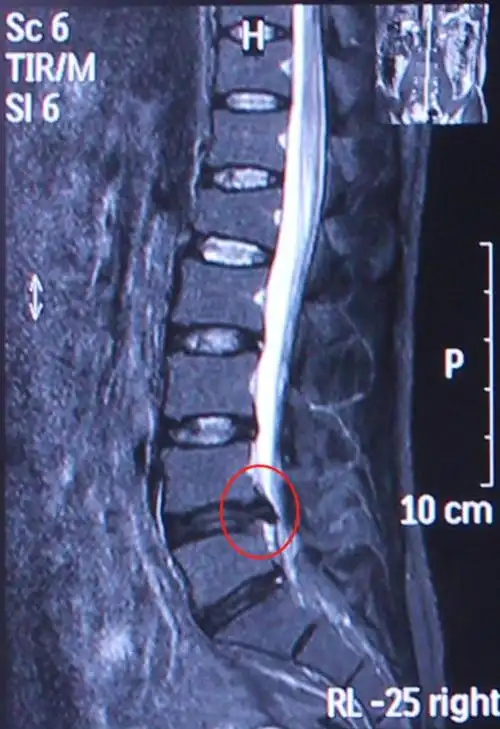 病例分享:当不敢休息的中年人遇见腰椎间盘突出症,该怎么办?