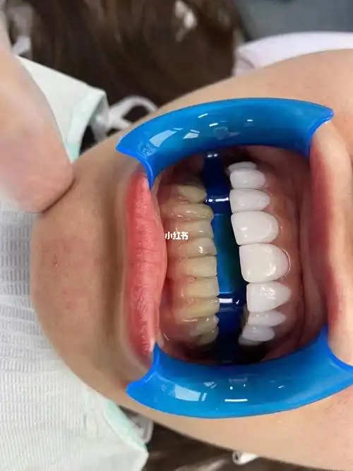 93♂1561甜春69冰瓷美牙 牙61美齿69白的缔造者_美牙_美