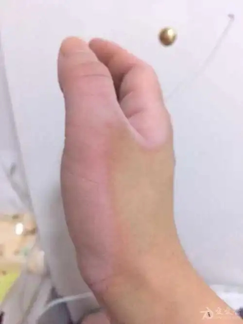 有奖猜图积分大派送六十水源性肢端角化症