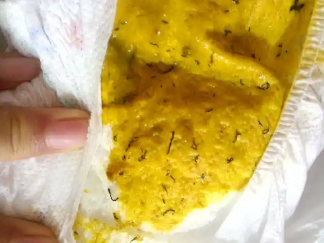 宝宝七个月,母乳喂养,早晨拉的便便里有黑色线一样的东西,这是怎么了