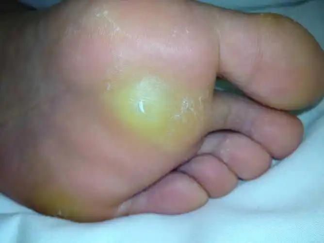 脚底板长了个东西,像老茧一样,平时走路碰到了会很疼,晚上用温水泡脚