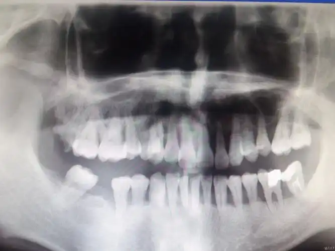 今天去拍了牙片感觉人生已经没意义了