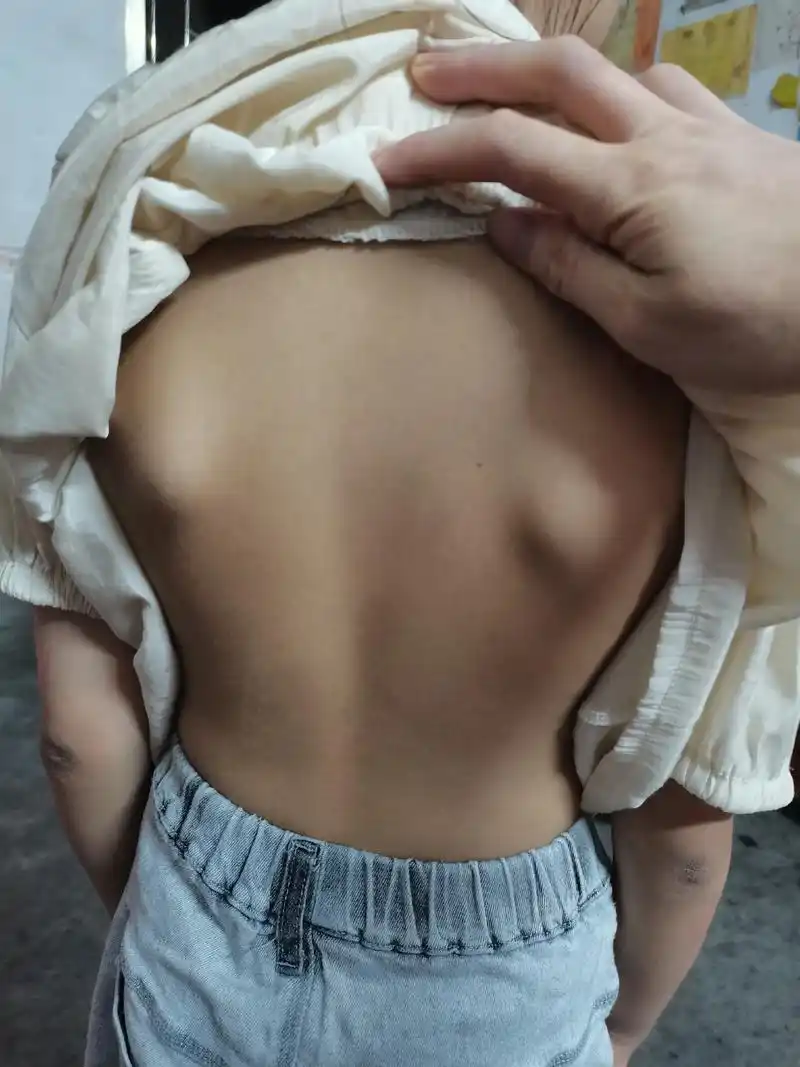 有没有抖音大神帮我看看,孩子肩胛骨这么突出正常吗