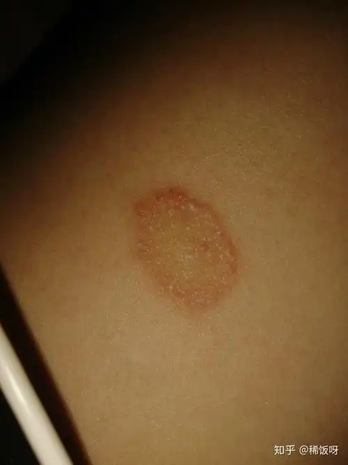 刚发病时很痒,很小一个圆圈,然后随着