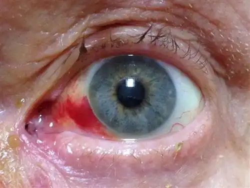 白睛溢血