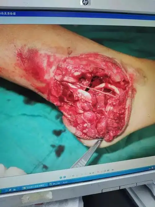 右足踝开放性损伤清创术后病例分享