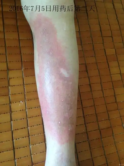 下肢丹毒病例