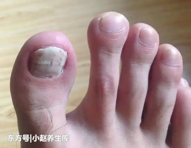 提醒:脚上出现6种表现,说明你的血糖太高了