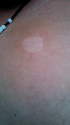 汗斑【多图】_39医疗图集-39健康网