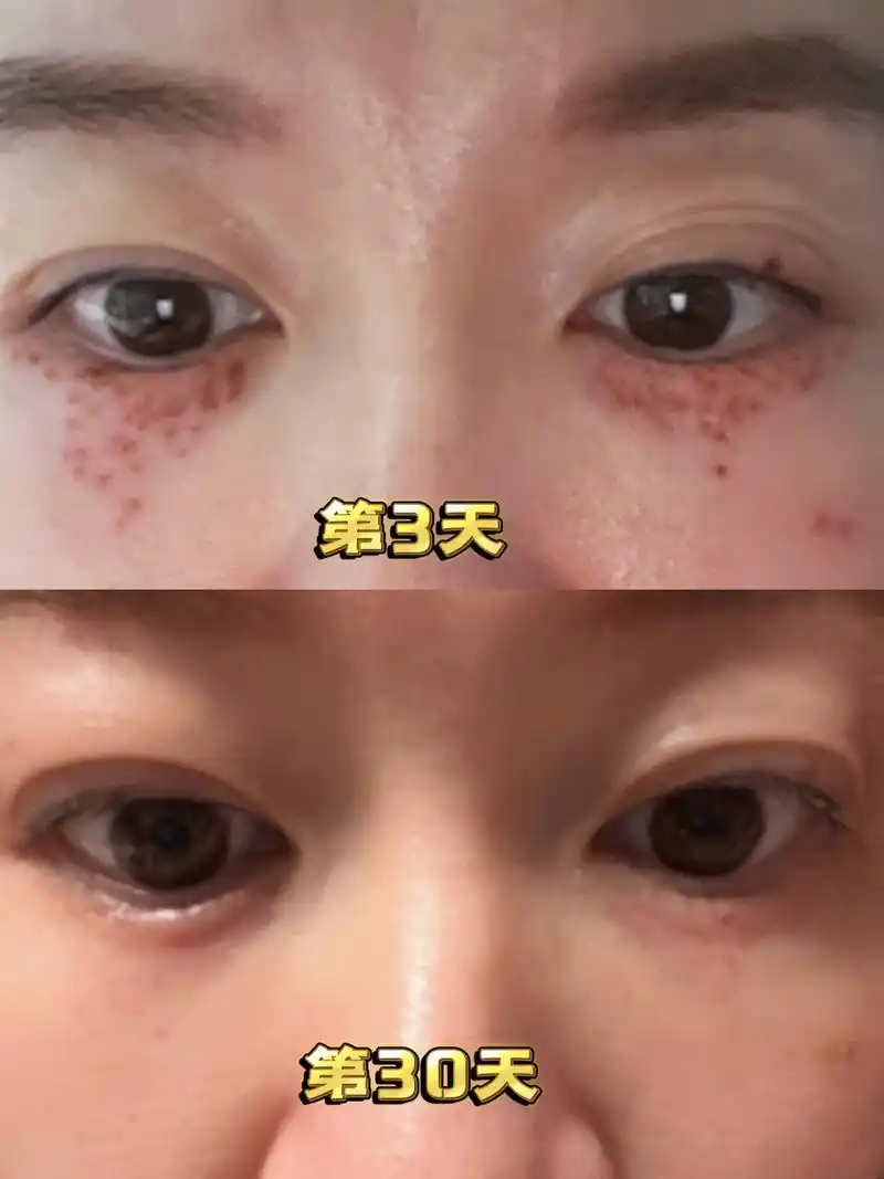 汗管瘤祛除第30天分享 汗管瘤,斑,痣祛除第30天啦啊 看样子完全恢复还