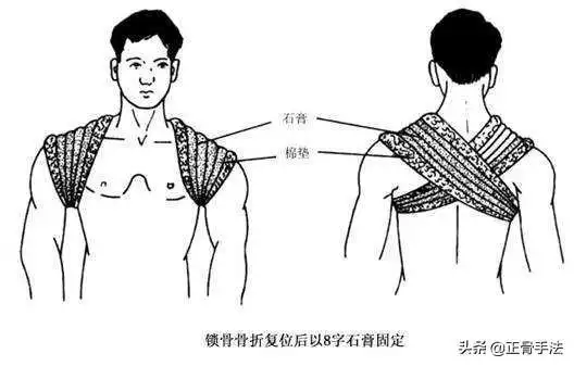 骨科八字绷带绑法