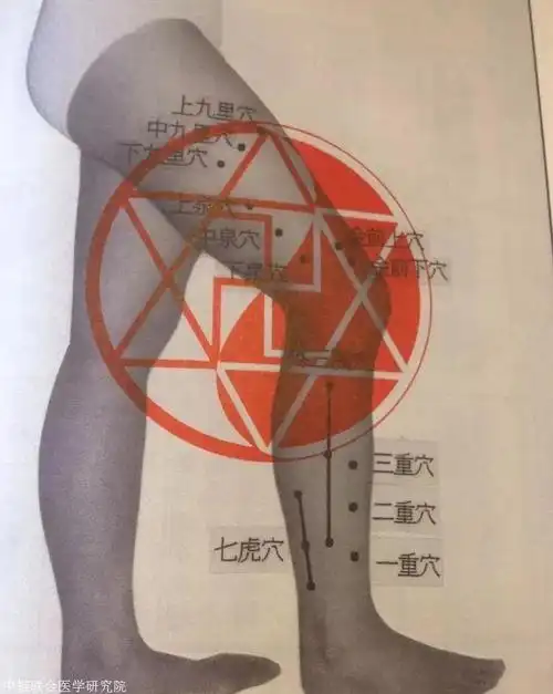 董氏针灸临床上治疗三叉神经痛的处方: 三重 ,三泉 ,灵骨大白 ,侧三里