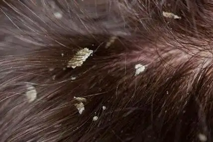 头皮上有白色大片的皮是怎么回事这四个疾病造成得及时改善