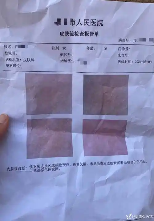 2岁女孩,背部白斑,求诊断?