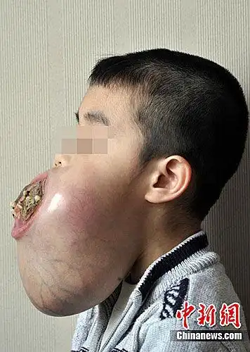 广西5龄童下颌骨长巨大肿瘤 手术成功康复出院