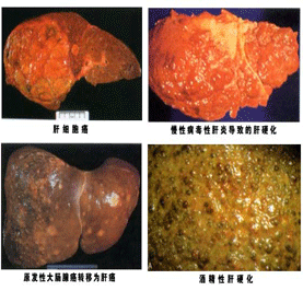 患了肝纤维化有哪些症状