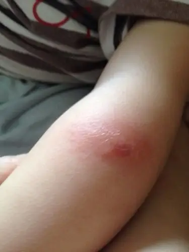 问:一岁五个月宝宝前天晚上被虫咬的,很大很硬很多小水疱,昨天睡觉