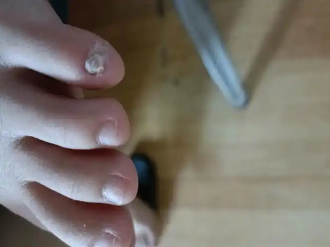 小脚趾的指甲特别难看怎么办