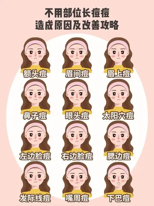 不用部位长痘原因改善攻略康康你是哪种