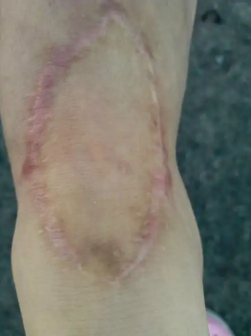 植皮的手术疤痕能用安佩丽丝给修复好吗