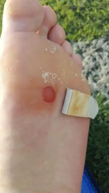 踢足球换了新鞋,把脚底磨掉了皮,里面的新皮是深