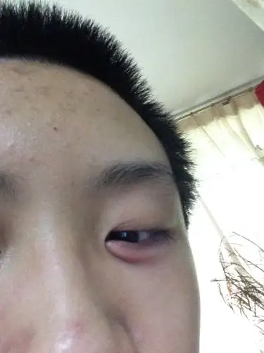 眼睛下方红肿怎么回事