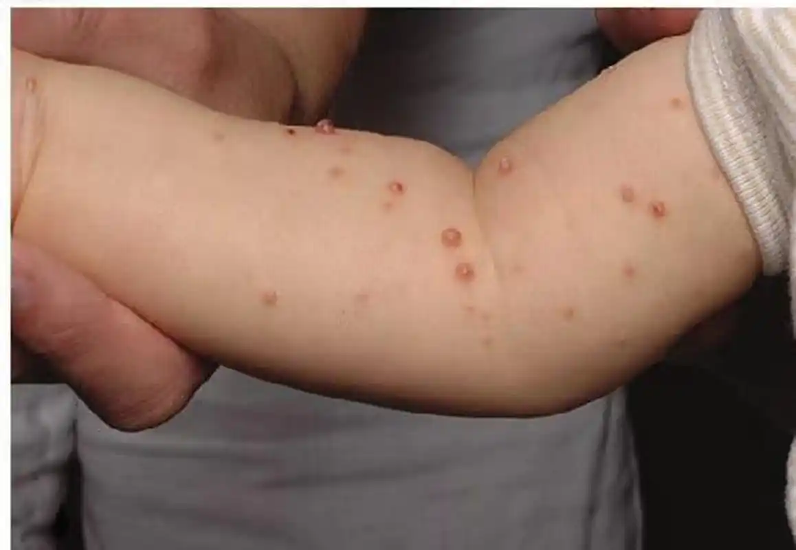 【宝宝身上长了会传染的"水瘊子",那种方法治疗起来最佳呢?