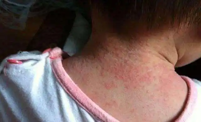 捏积派——夏季来袭,宝宝长痱子怎么办?如何预防护理?