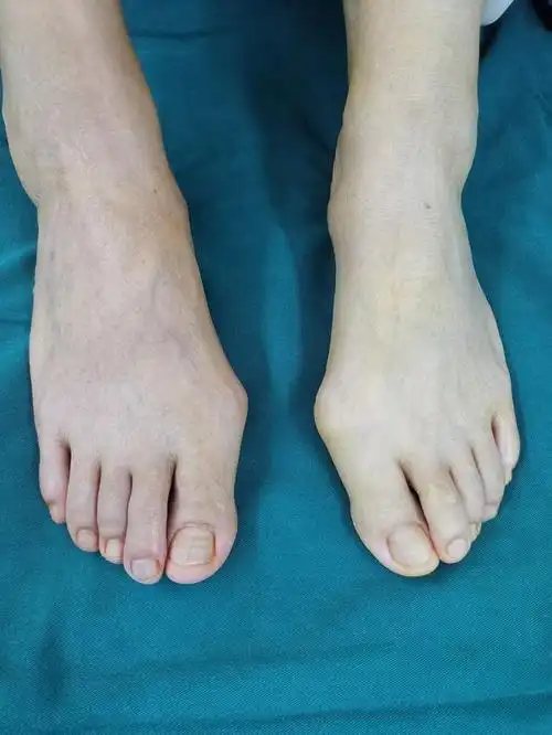 x光片左侧术前x光片右侧术后x光片术后x光片一组简单的拇外翻手术图片