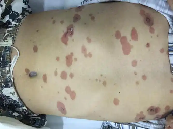 多形红斑型药疹