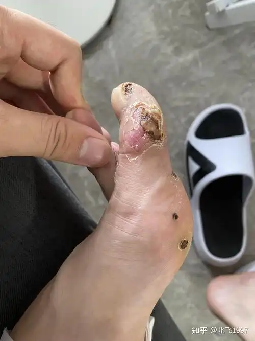 激光治疗趾疣历程记录分享