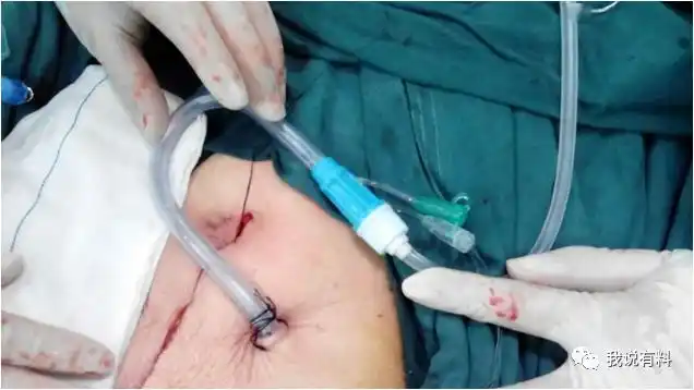 多功能引流管(腹腔双套冲洗引流管)的临床应用和护理