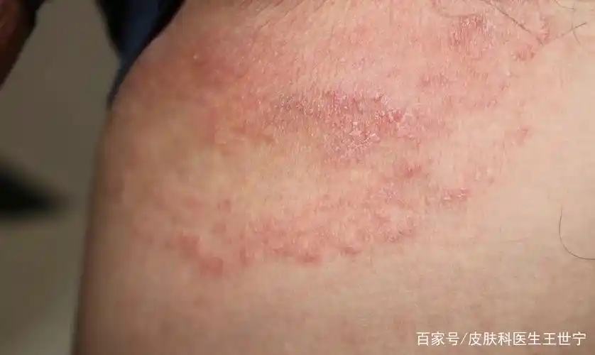 这几个皮肤病都是真菌感染,都伴有瘙痒!