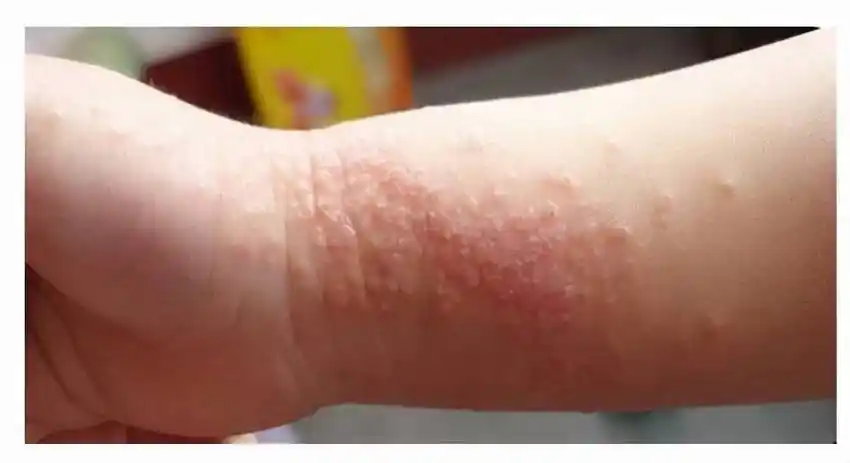 湿疹一般多久能好(热毒湿疹要多久才会好)_句子贝贝