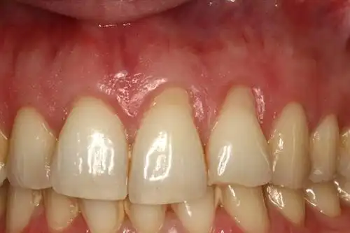 牙龈萎缩