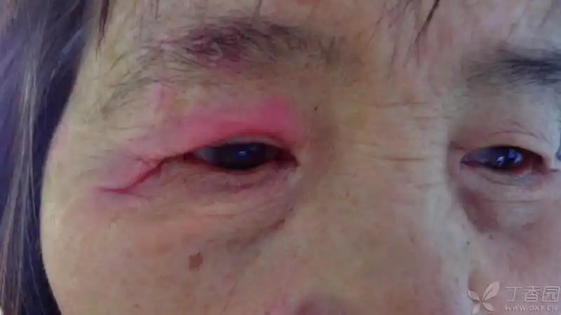 【病例】上眼睑红肿是炎症还是过敏?(图片有更新)