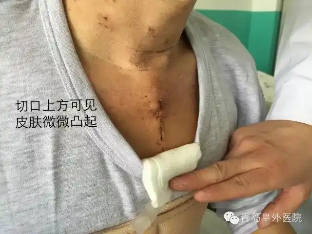 32个冠脉搭桥手术疑问最详尽的解答